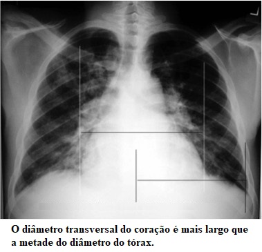 Insuficiência cardíaca, radiografia