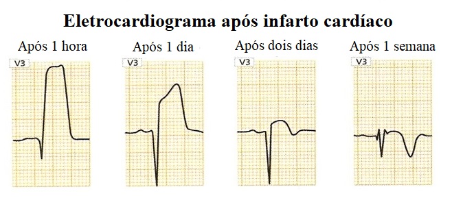 onda-q, infarto, variações, ECG
