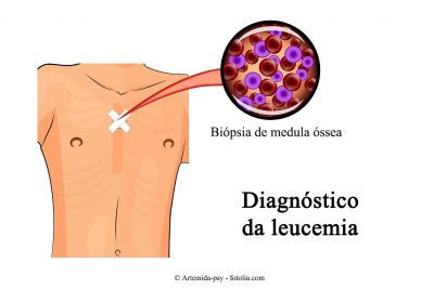 Leucemia-diagnóstico-biópsia-medula