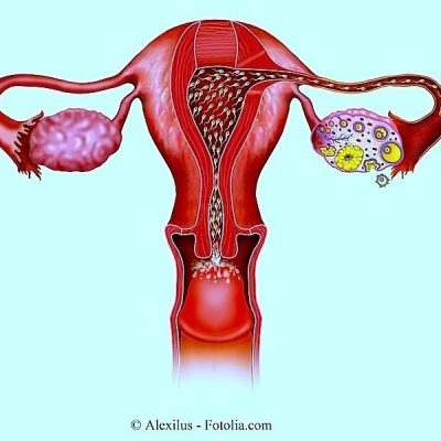 Doença do ovário e do utero