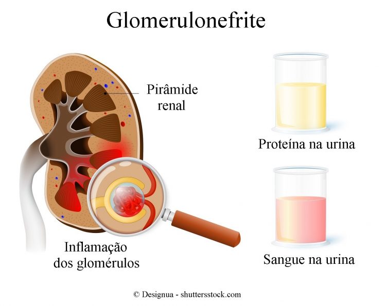 glomerulonefrite