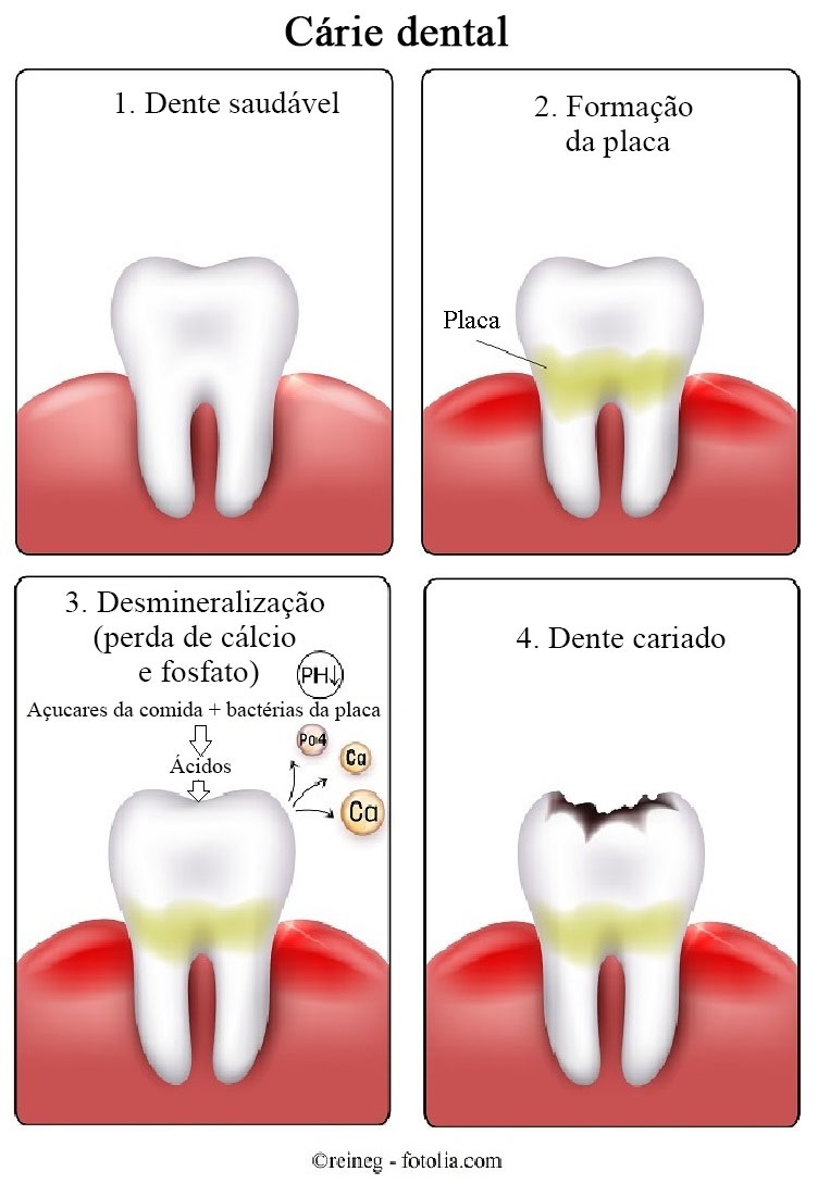 Cárie-dental