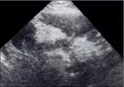 ultrassonografia, pancreatite aguda edematosa