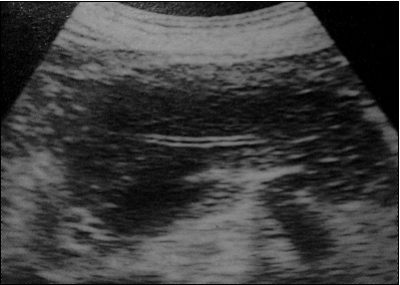 Pancreatite aguda hemorrágica necrosante, ultrassonografia