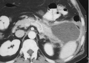 tomografia, pancreatite aguda hemorrágica necrosante