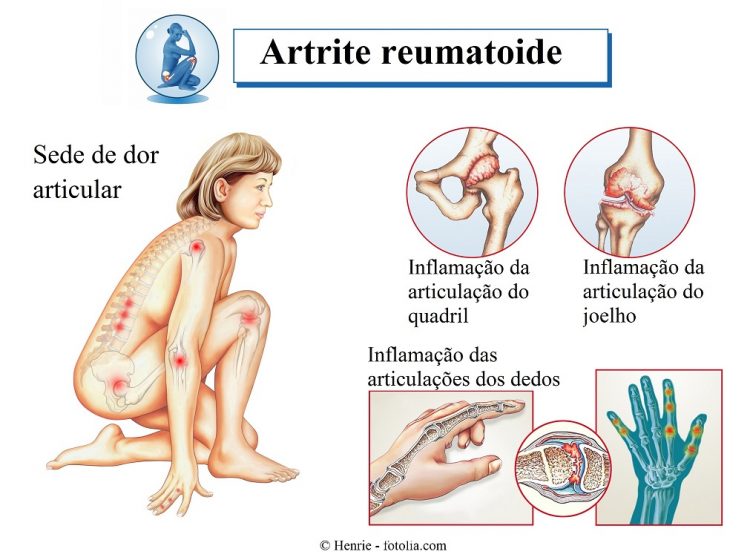 O que é artrite reumatóide juvenil e quais tratamentos são eficazes