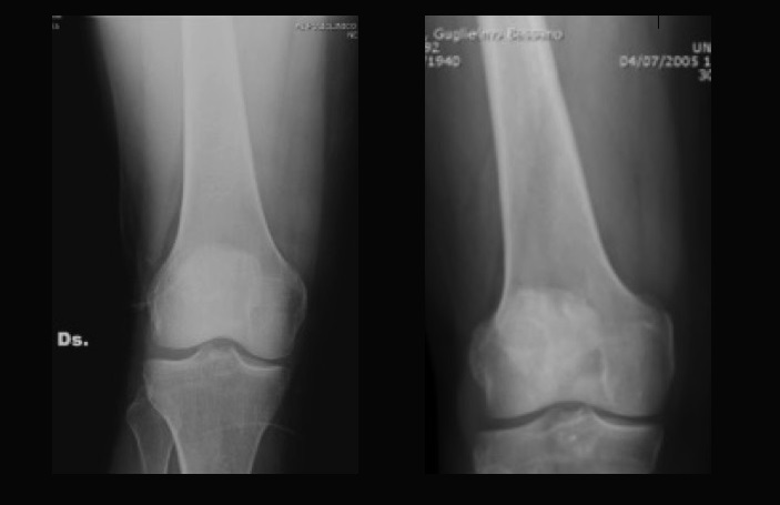 Osteossarcoma-no-joelho