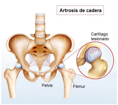 Artrosis de cadera