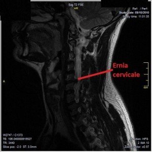 RM del disco intervertebral, hernia, medial, paramedial
