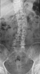 Escoliosis lumbar convexa derecha, radiografía, lumbar, espalda, giba, espalda, postura