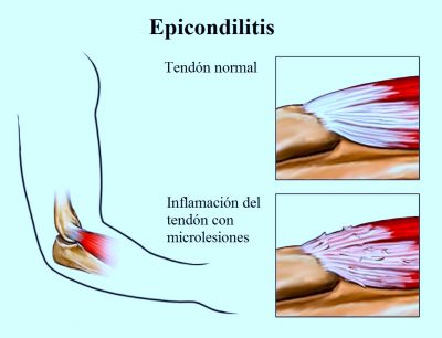 epicondilitis