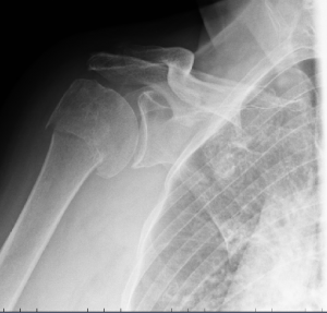 Radiografía del hombro, húmero, fractura, miembro superior