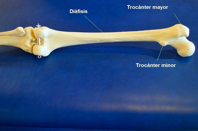 Fractura de cadera, cabeza de fémur, acetábulo