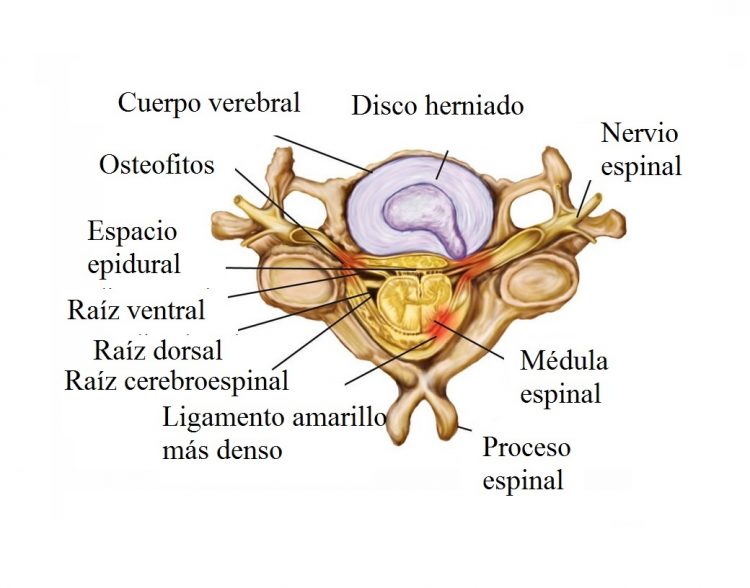 hernia discal