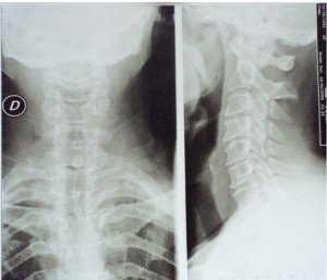 radiografía del cuello, cráneo, edad, ancianos, artrosis, hueso, vértebra, dolor