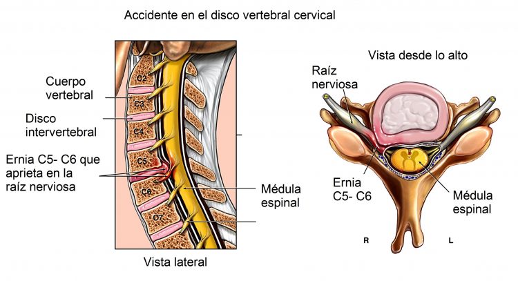 artrosis cervical