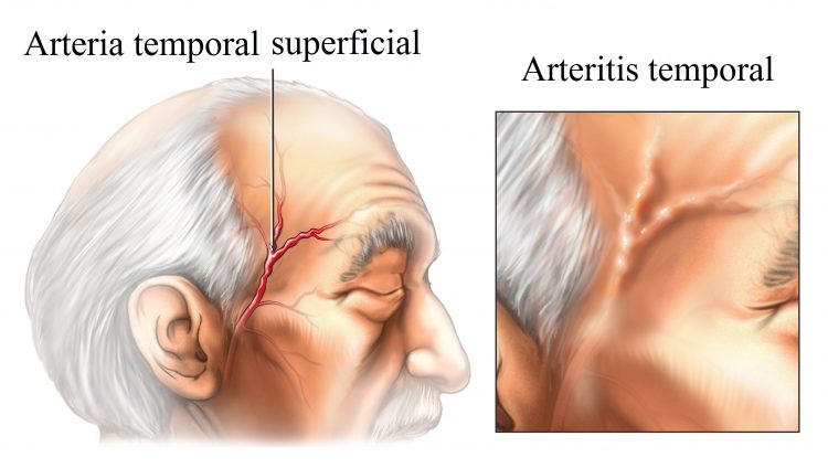 arteritis temporal