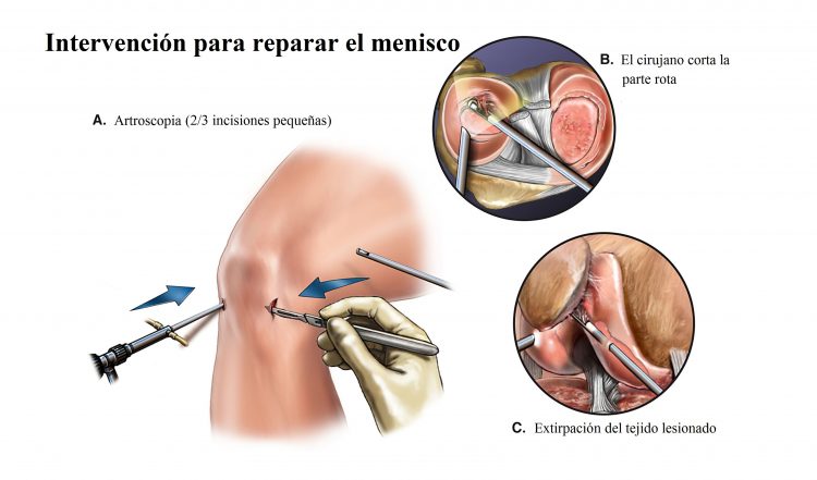 Intervencion para reparar el menisco
