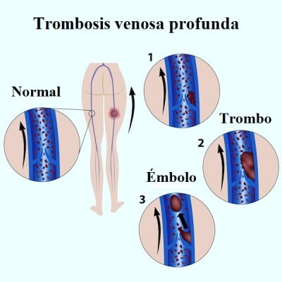 trombosis, venosa, profunda, embolia, cirugía, inmovilización, prótesis
