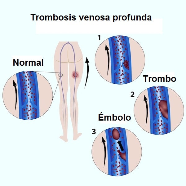 Trombosis, venosa, profunda, flebitis, coágulo, trombo