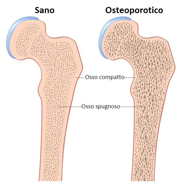 osteoporosis, régimen efecto, hueso, densidad, dolor, fractura, rotura