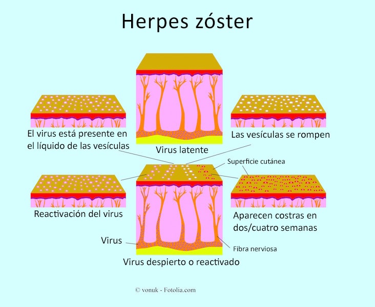 Herpes zóster