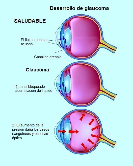 glaucoma, presión, ojo, visión de la ceguera, rojo, dolor
