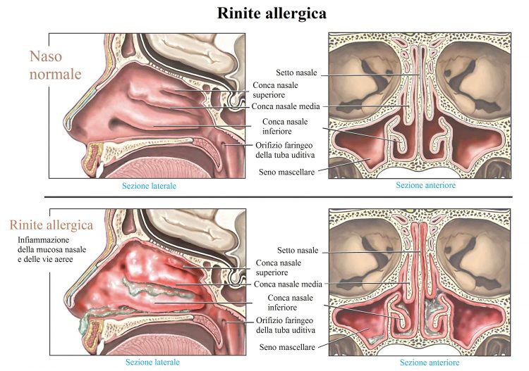 rinite-allergica-750x527