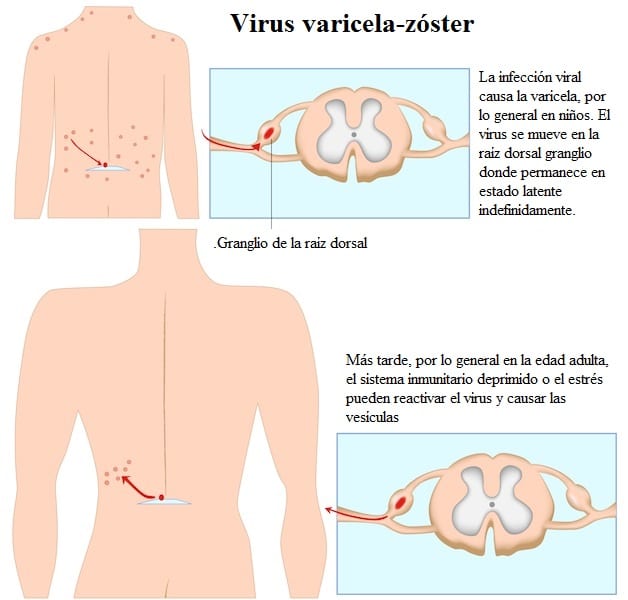 virus-varicela-zóster