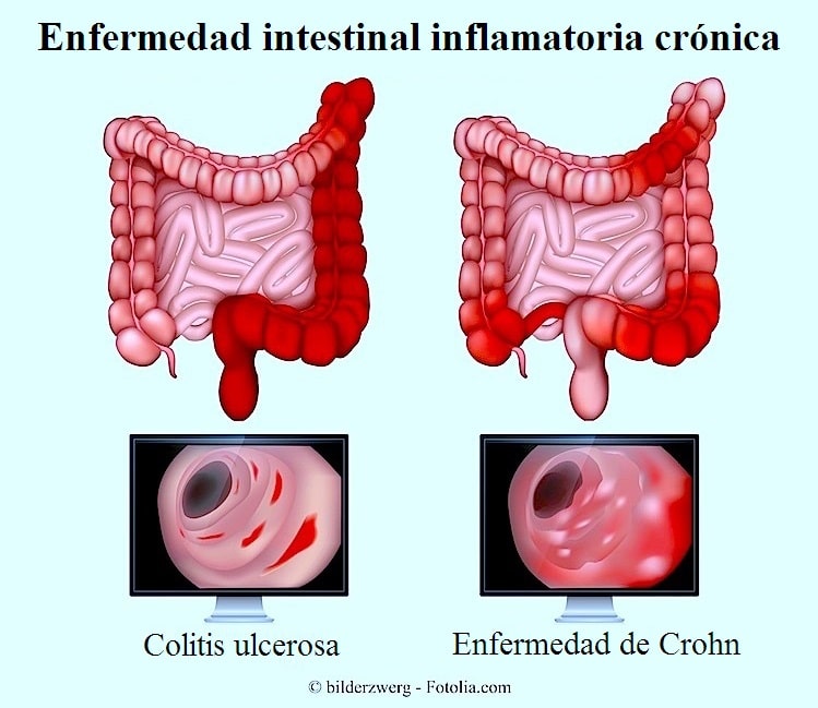 Colitis ulcerosa, enfermedad de Crohn