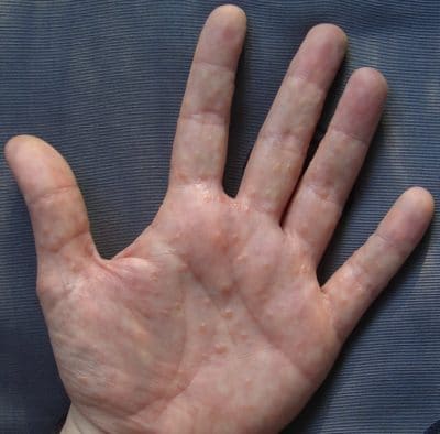 Dishidrosis en las manos