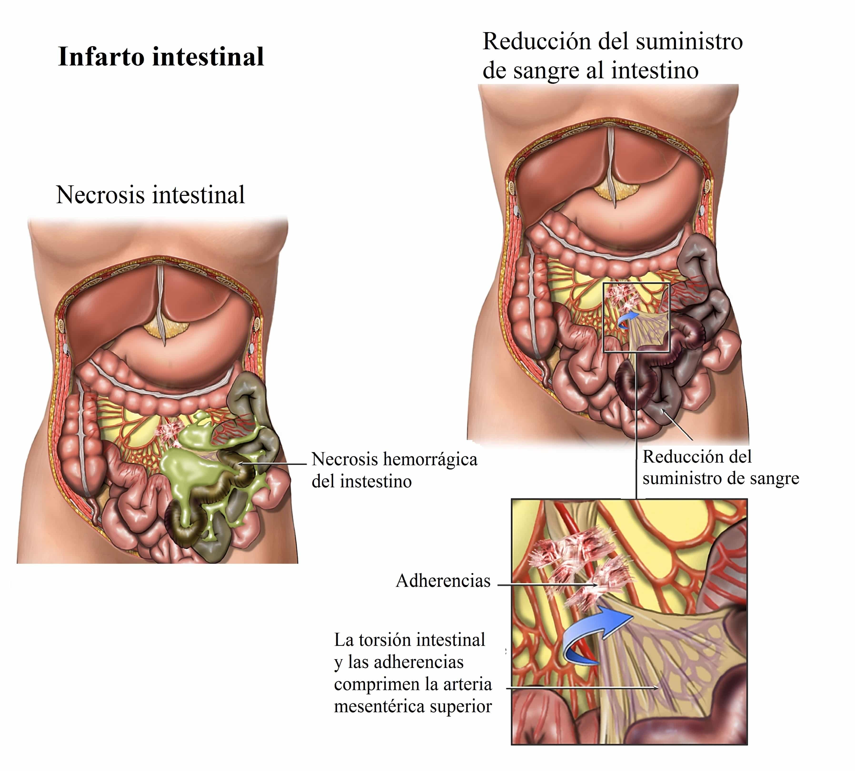 infarto-intestinal-necrosis