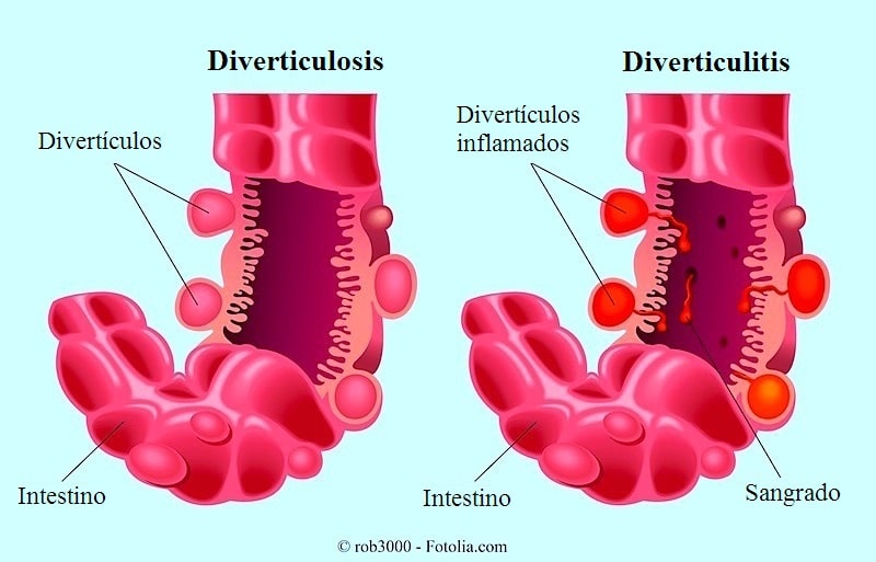 Diverticulitis y diverticulosis