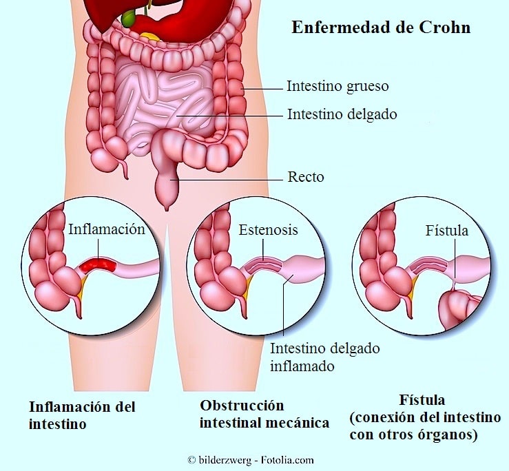 Enfermedad de Crohn