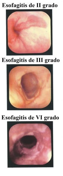 Esofagitis,grado,II,III,IV