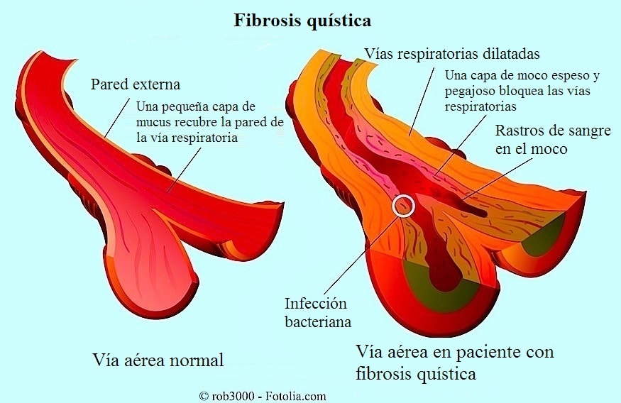 fibrosis quística, vías respiratorias