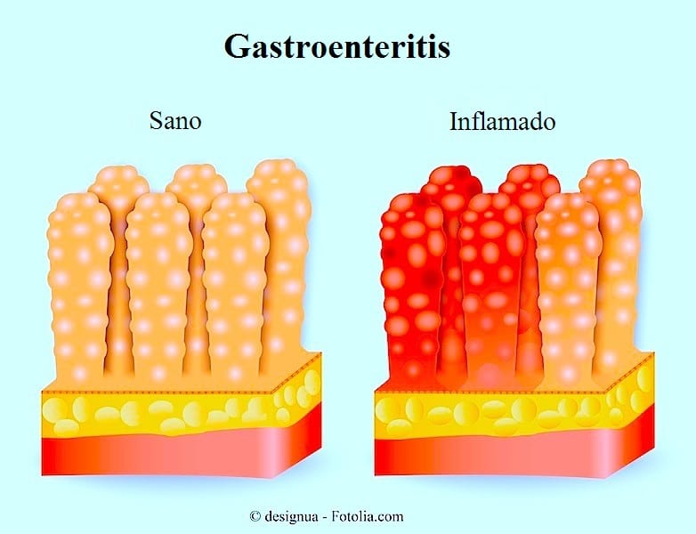 Gastroenteritis o gripe intestinal