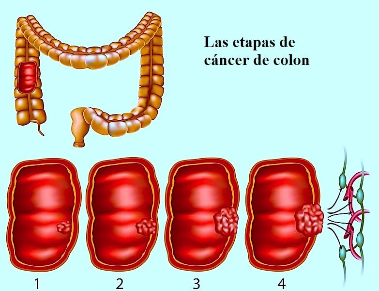 Tumor, colon, intestino, cáncer, dolor, difusión, tamaño, lesión