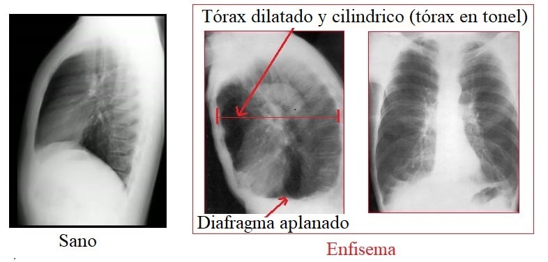 Radiografías de Tuberculosis, Enfisema y Neumotorax – yanes escobar