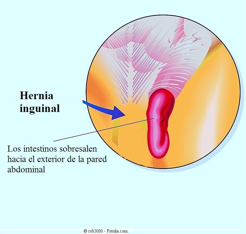 Hernia inguinal- síntomas, complicaciones y cirugía