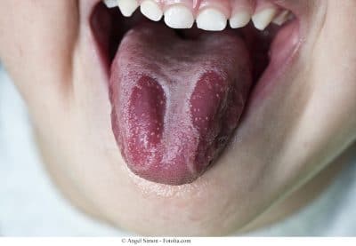 cándida bucal, candidiasis, oral, lengua