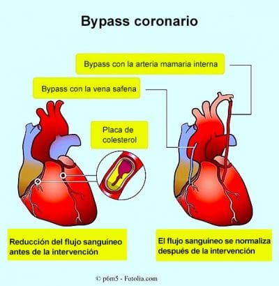 Bypass coronario