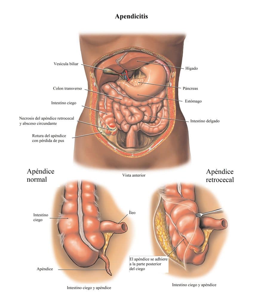 apéndice, apendicitis, abdomen