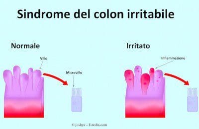 colon-irritabile-400x260