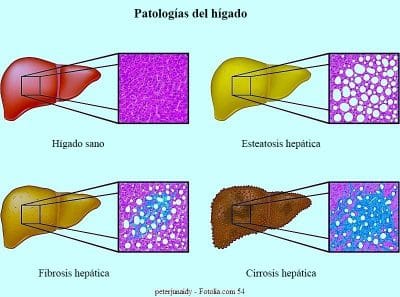 higado-enfermo-hepatitis-c