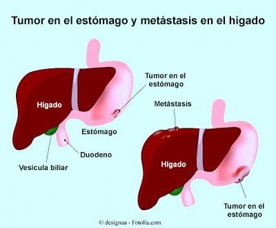 metastasi-del-higado