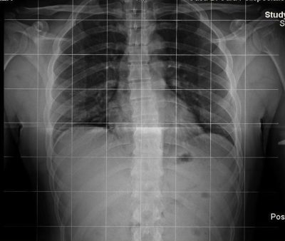 radiografía, tórax, pecho