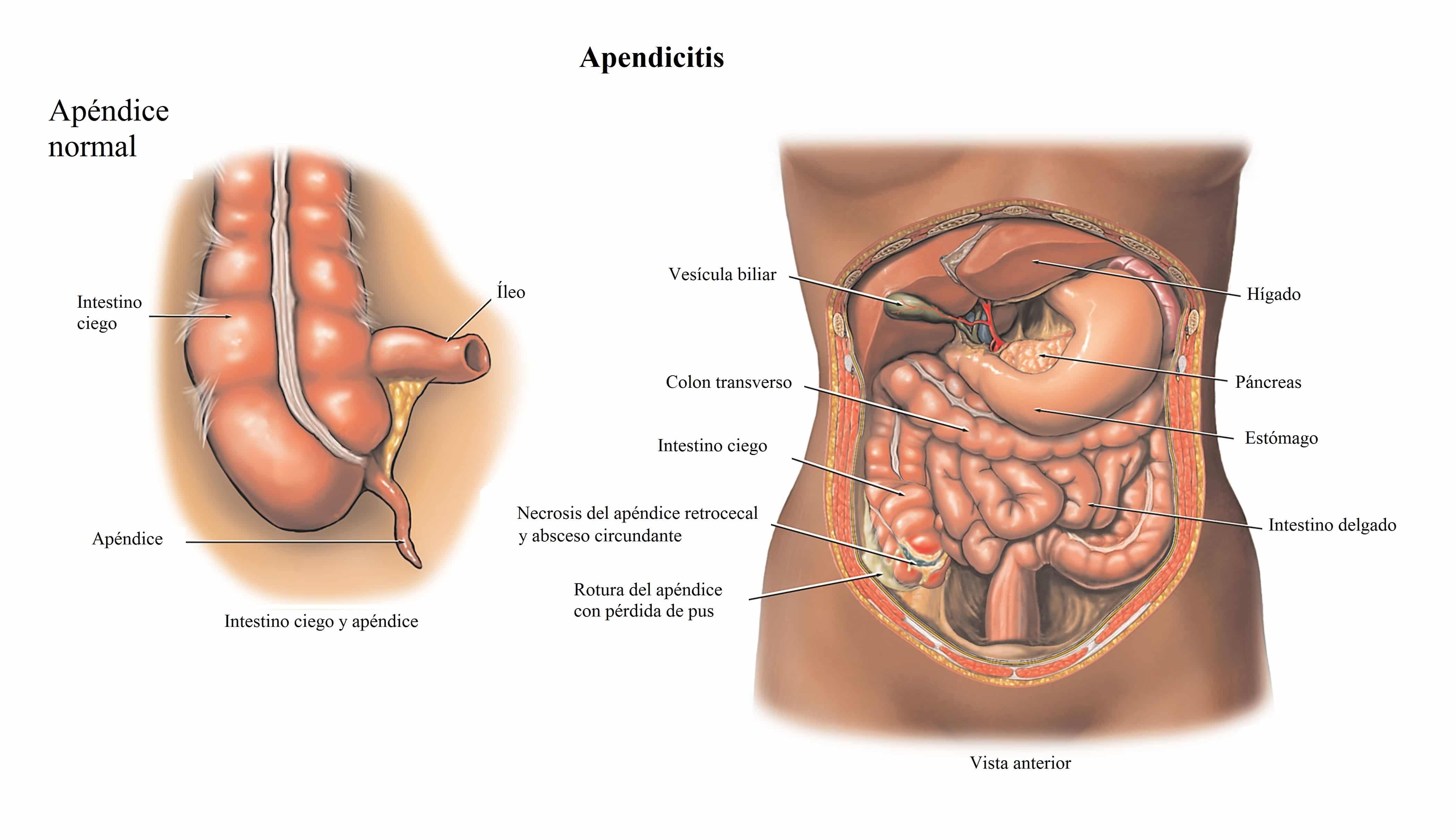 Donde esta la apendicitis mujer