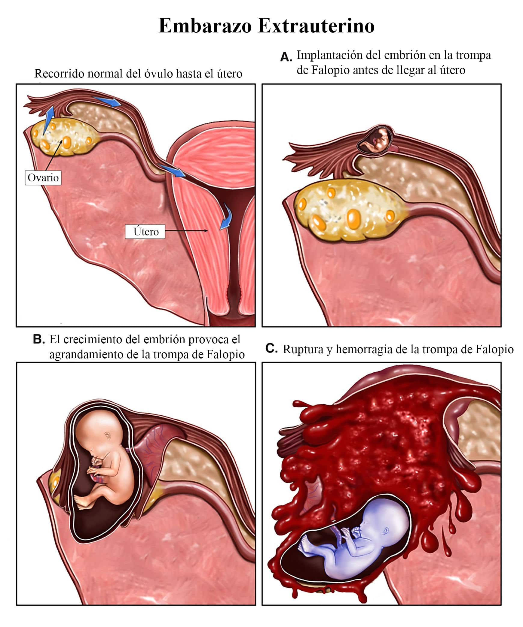 embarazo-extrauterino