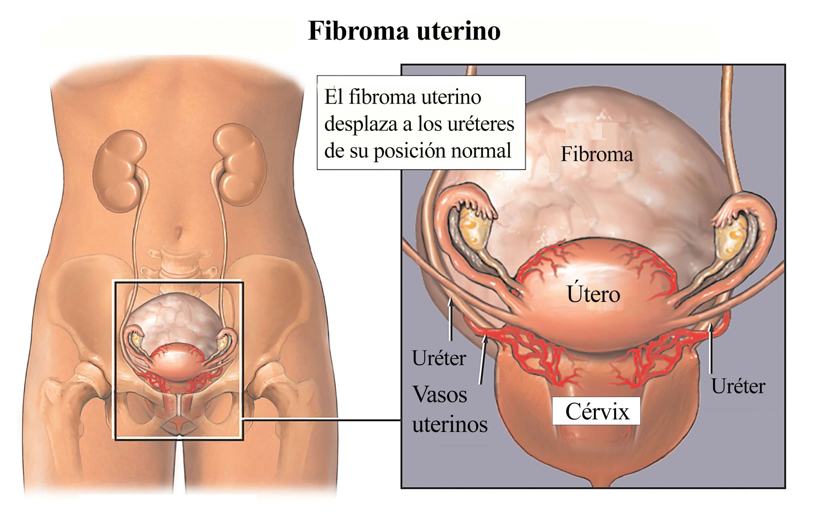 fibroma-uterino